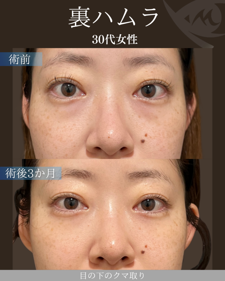 30代女性　裏ハムラ法　術後3か月